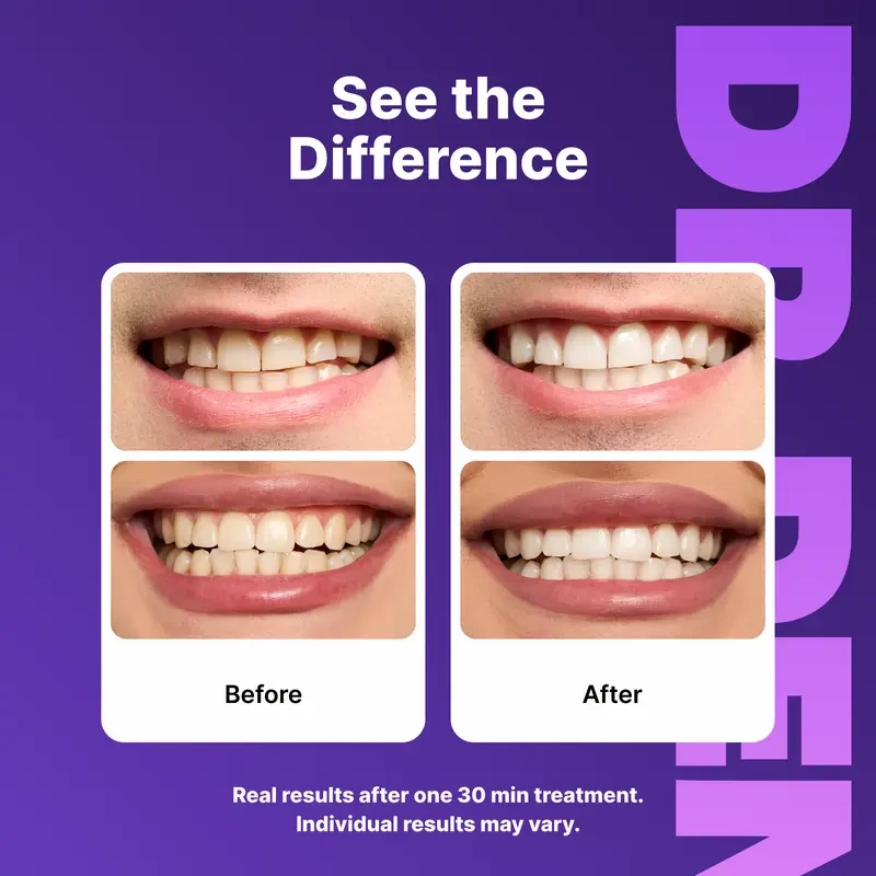 DrDent Peroxide-Free Purple Teeth Whitening Strips